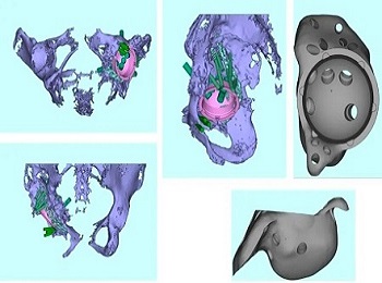 【医工结合】使用3D打印多孔钽金属假体对严重骨盆缺损患者进行髋关节翻修重建手术