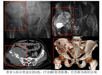 利用3D打印多孔钽金属假体成功治疗骨盆巨大恶性肿瘤