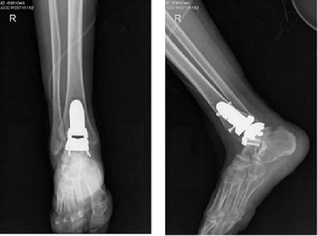 医院成功完成3D打印多孔钽生物型假体踝关节置换术