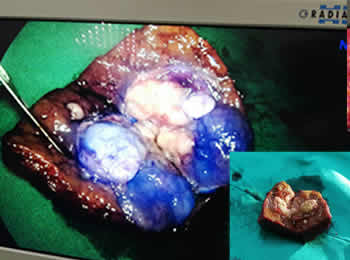 大连首例吲哚菁绿导航荧光腹腔镜下肝癌手术在我院完成