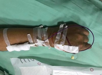 介入科成功实施我院首例经远桡动脉穿刺的肝动脉化疗灌注术